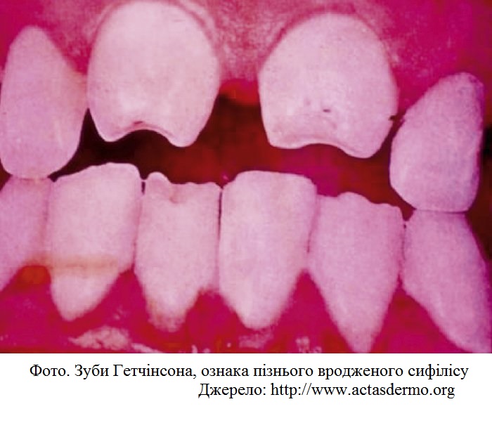 aa_2_2_l_13_TORCH_32